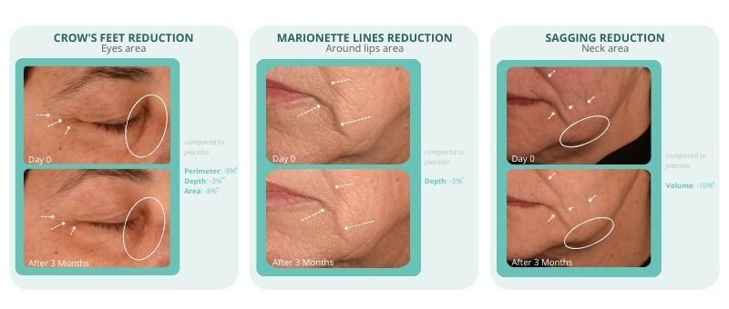 Clinical photos demonstrating EcoPep's visible results over 3 months, showing significant reduction in crow's feet wrinkles, marionette lines, and facial sagging.