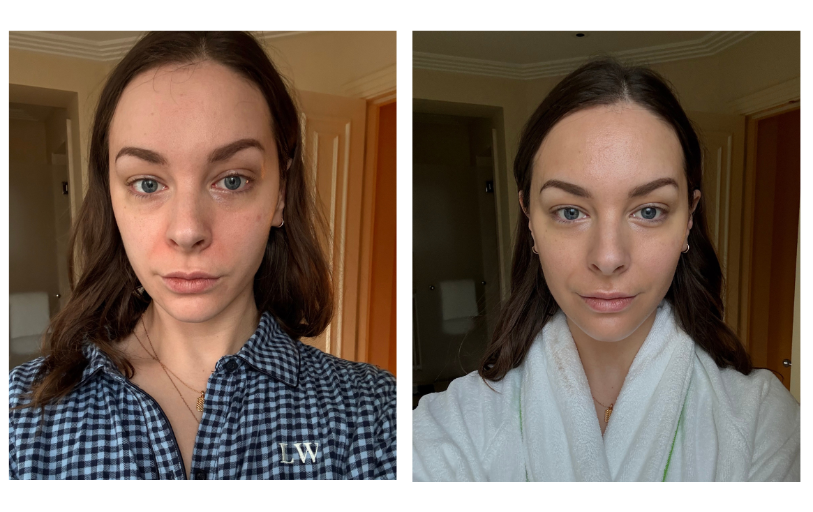 Lyma laser Lottie Winter review