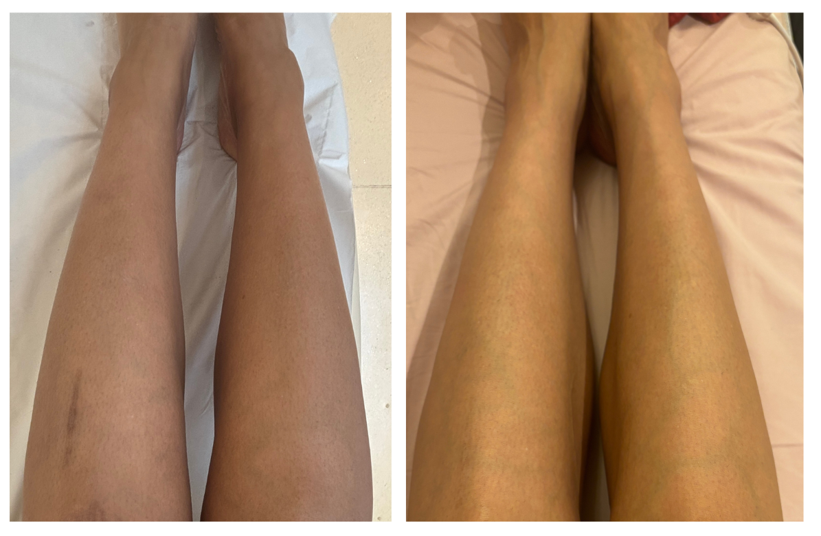 Amerley Ollennu before &amp;amp; after UltraClear Laser